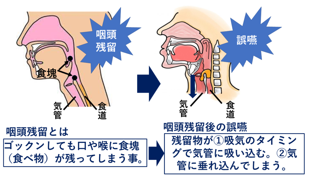 喉頭がんのリスクを低下させる